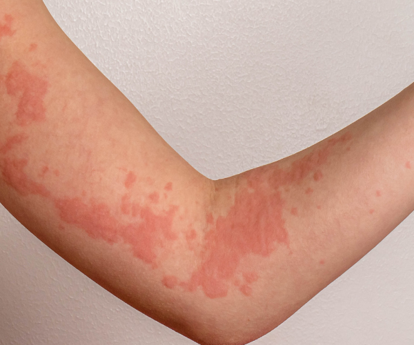 Urticaria por estrés: síntomas, causas y tratamiento eficaz